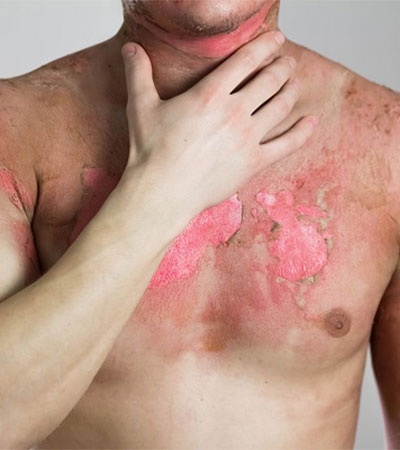 Burn Reconstructions surgery in Ongole